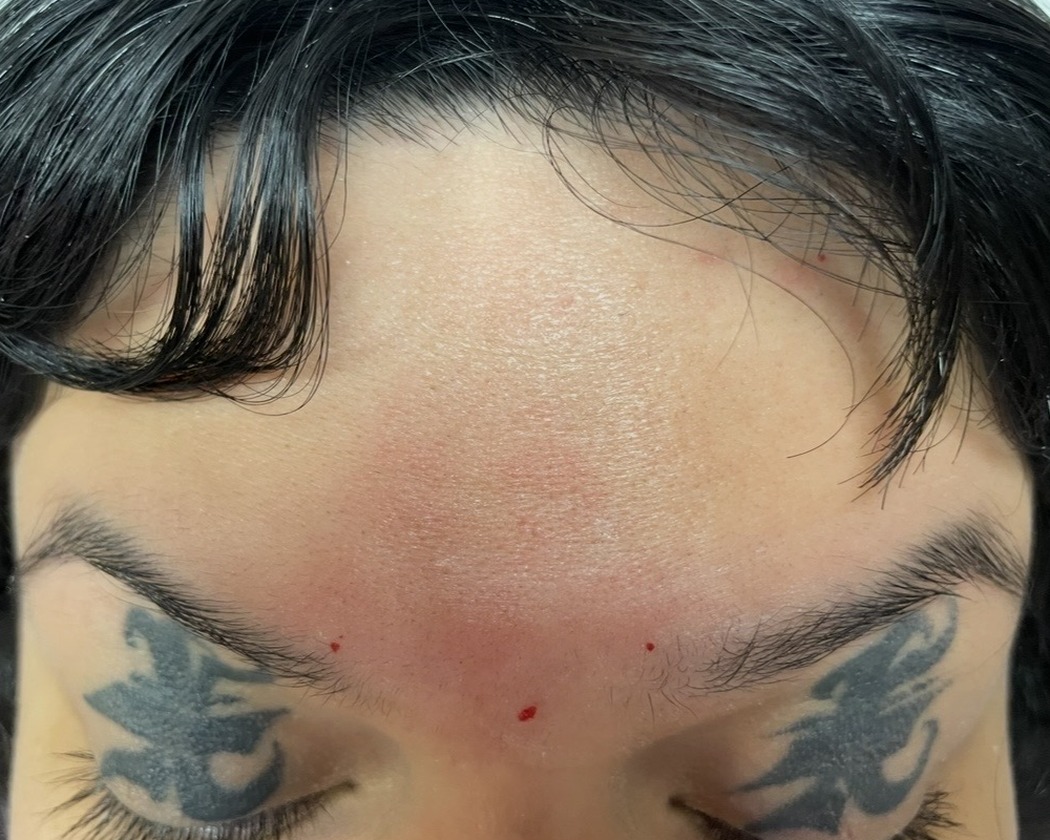 After Botox treatment showing a smoother forehead