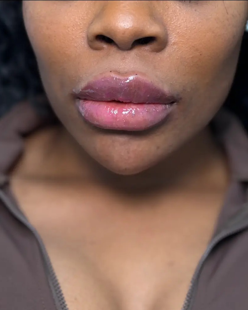 After chin filler treatment with lip filler also performed, shown from the front