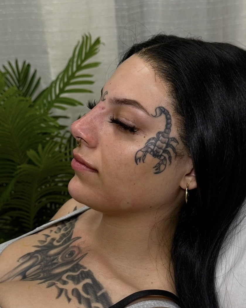 Facial balancing after treatment, shown in side profile