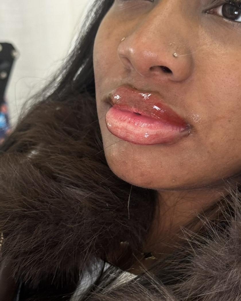 Immediately after lip blushing treatment