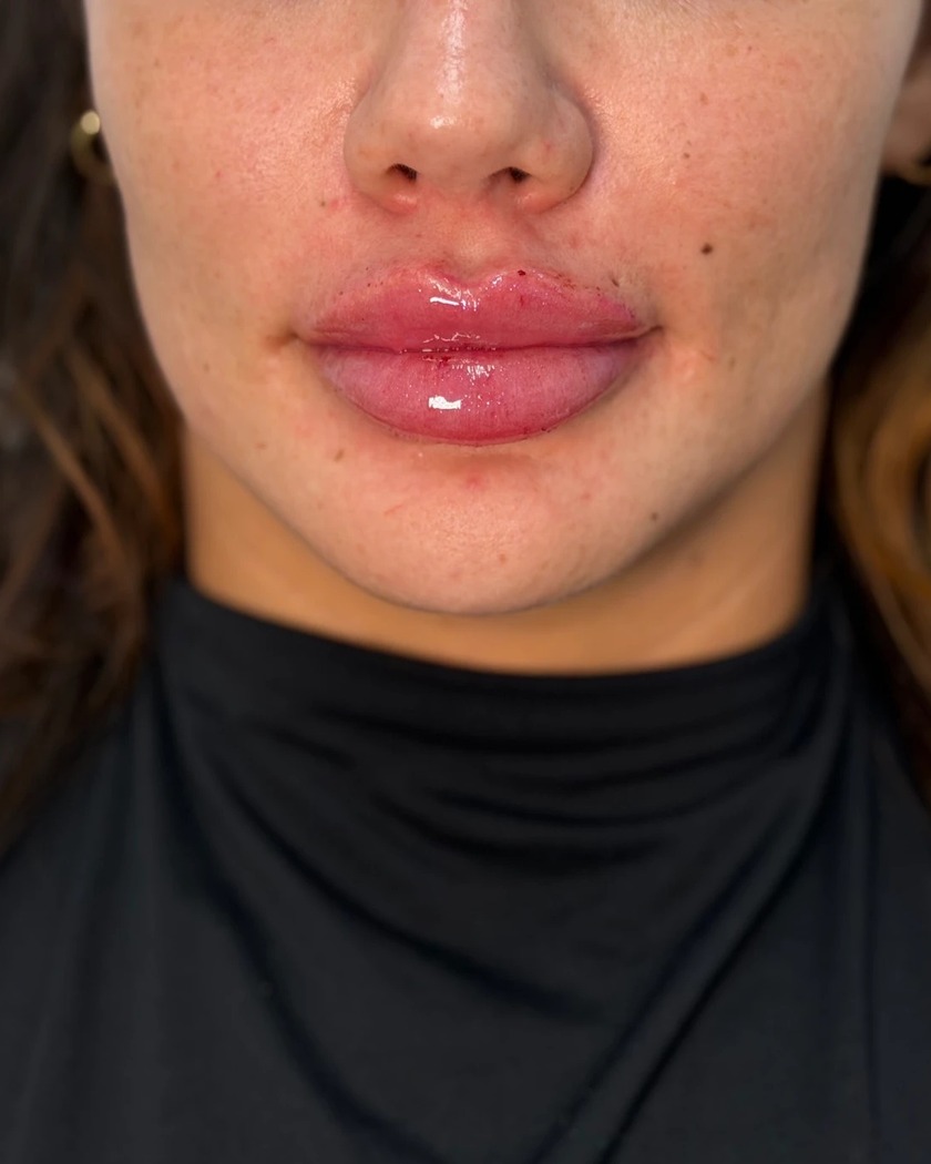 Lip filler after treatment, front view