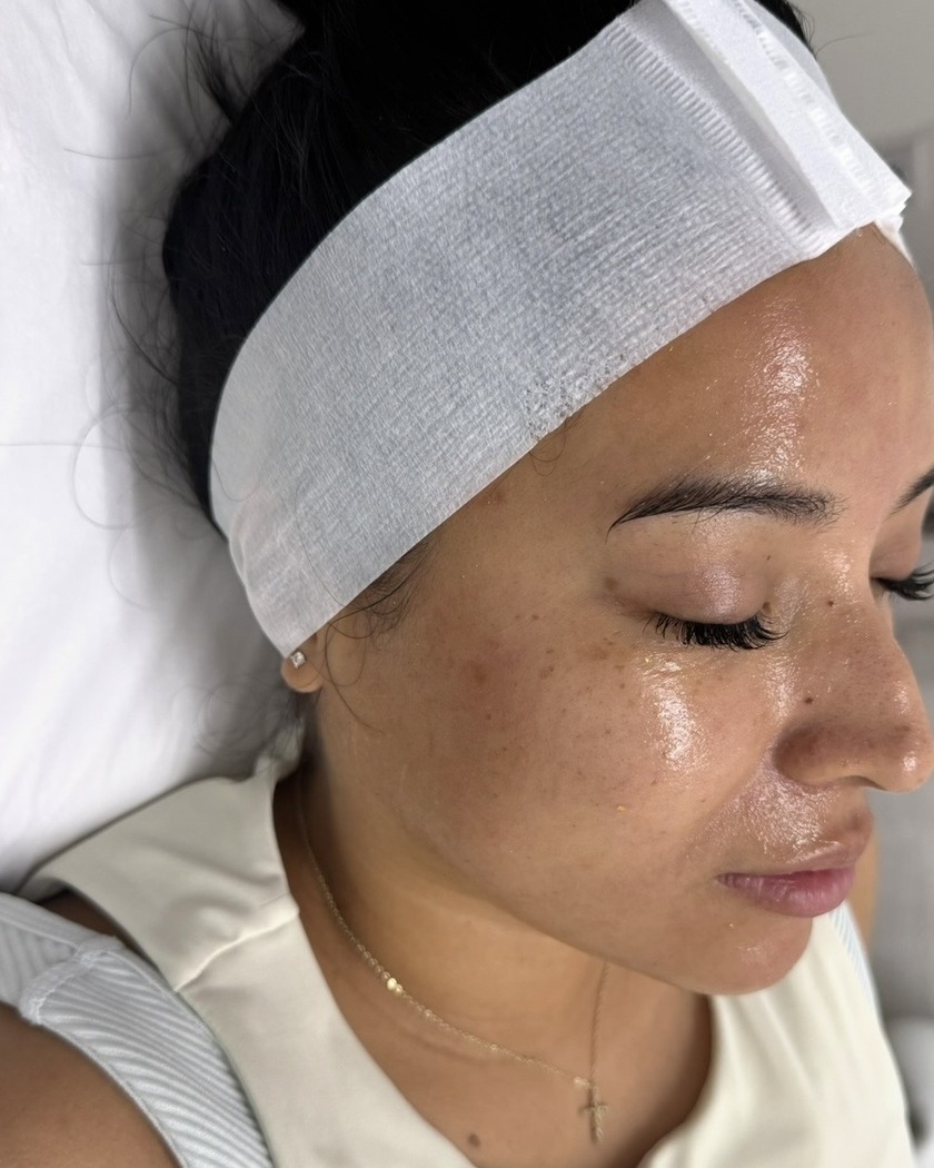 PRP Microneedling after treatment, shown from a three-quarter angle