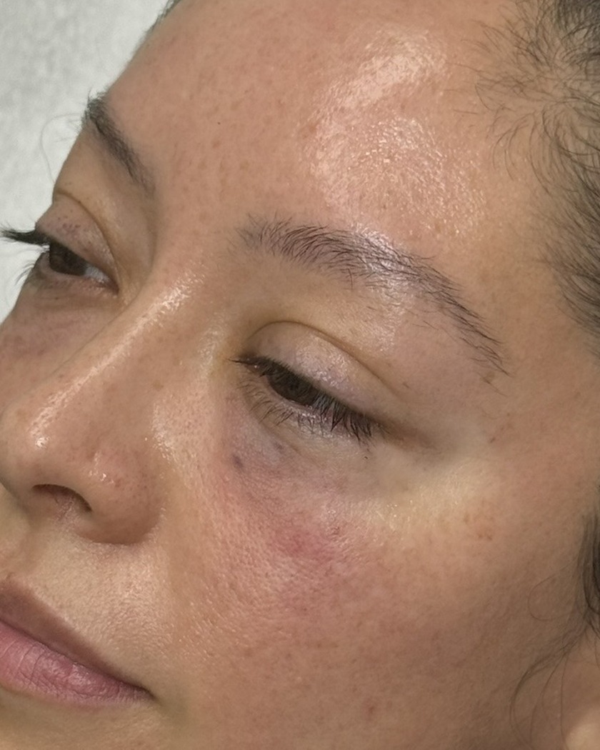 After under-eye PRF treatment